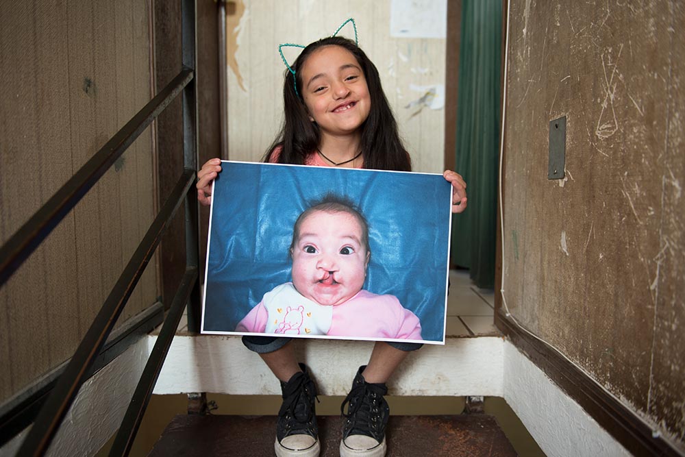 Camila holds image of herself before cleft surgery