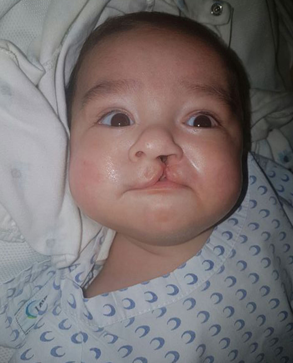 Baby Damián before cleft surgery