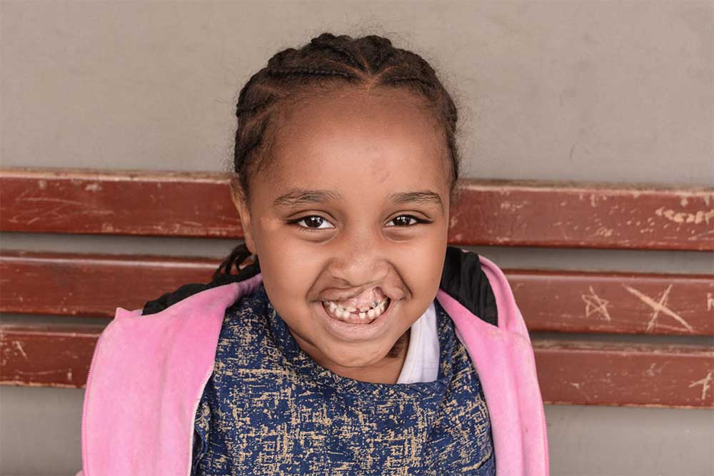Mariam smiling before cleft surgery