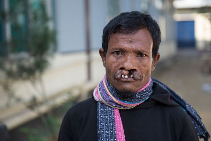 Mohammad before Cleft Lip Surgery